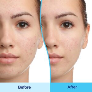 Differin? 0.1% Adapalene Gel Acne Treatment, 45-gram Pump Bottle - Image 8